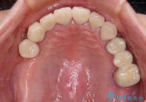 治療途中で放置してしまった前歯　オールセラミッククラウンによる補綴治療の治療後