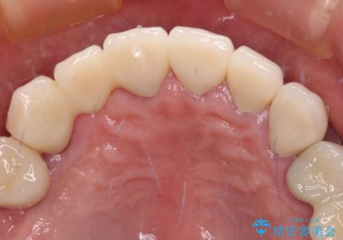 治療途中で放置してしまった前歯　オールセラミッククラウンによる補綴治療の治療後