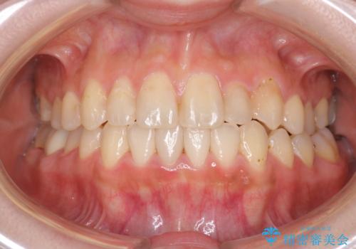 八重歯をインビザラインで非抜歯矯正の症例 治療後