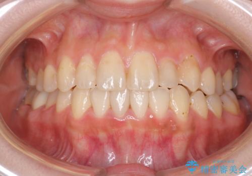 八重歯をインビザラインで非抜歯矯正の治療後