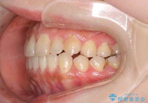 八重歯をインビザラインで非抜歯矯正の治療後