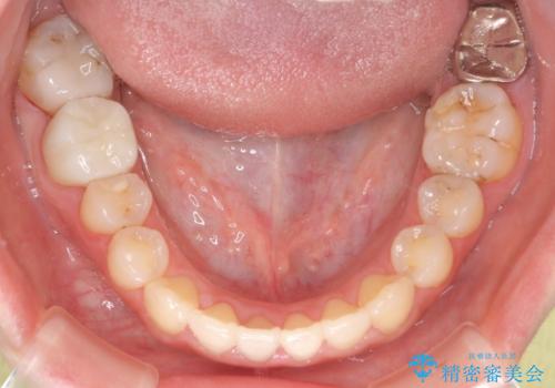 八重歯をインビザラインで非抜歯矯正の治療後