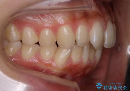 【前歯の見た目をキレイにしたい、引っ込んだ歯も気になる】インビザライン症例の治療前