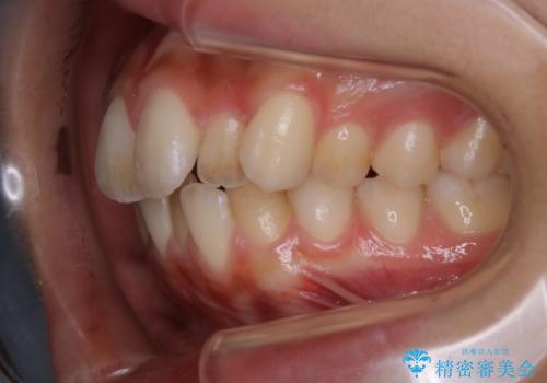 【前歯の見た目をキレイにしたい、引っ込んだ歯も気になる】インビザライン症例の治療前