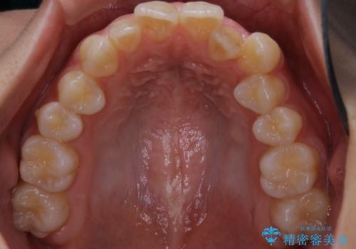 【前歯の見た目をキレイにしたい、引っ込んだ歯も気になる】インビザライン症例の治療前