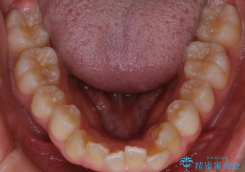 【前歯の見た目をキレイにしたい、引っ込んだ歯も気になる】インビザライン症例の治療前