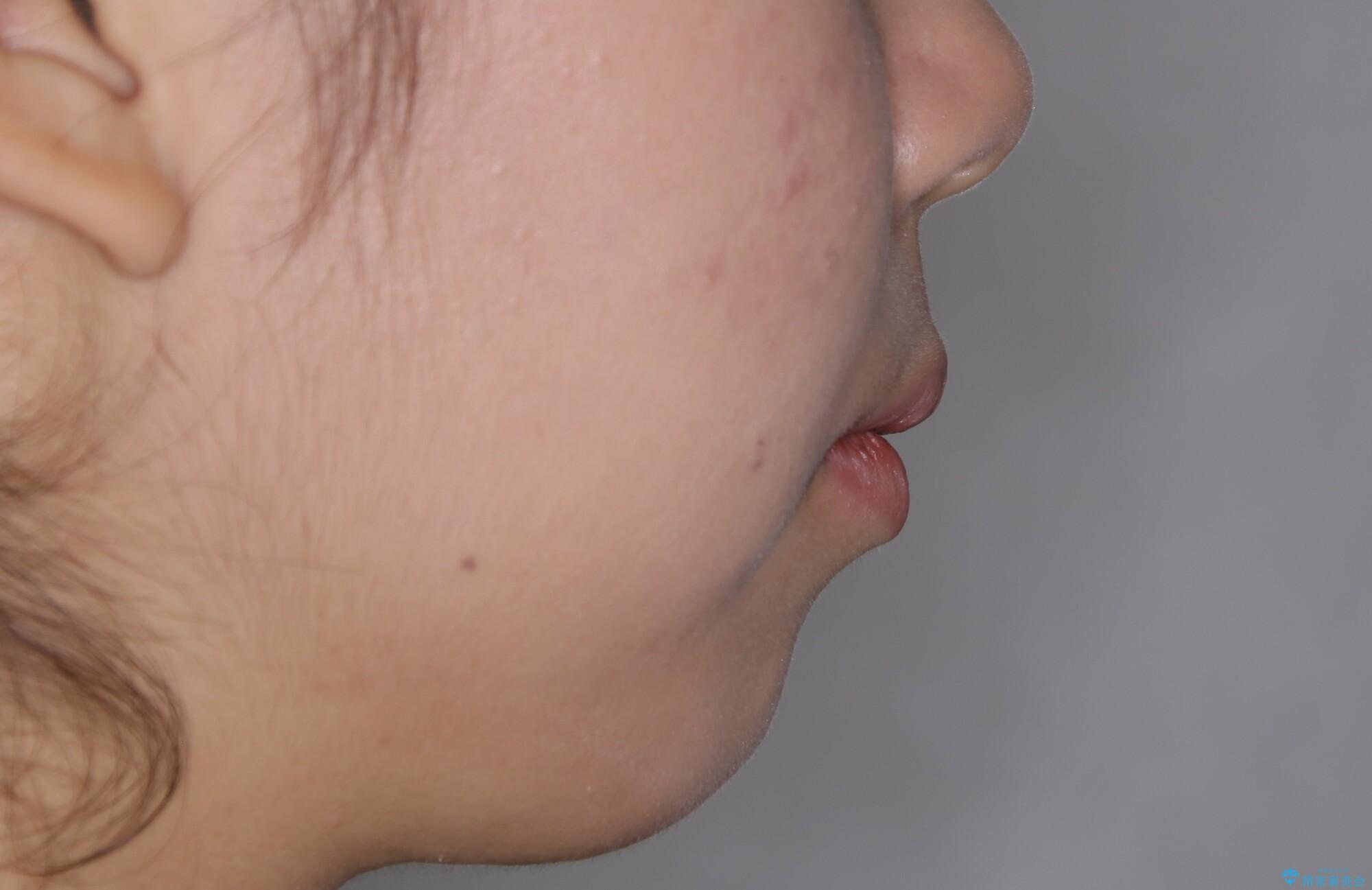 【前歯の見た目をキレイにしたい、引っ込んだ歯も気になる】インビザライン症例の治療前(顔貌)