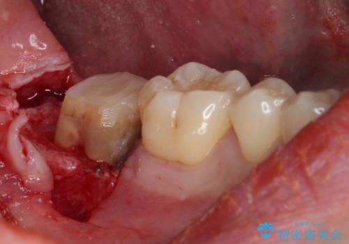 被せものが入れられない 外科処置を行ったセラミック治療の治療前