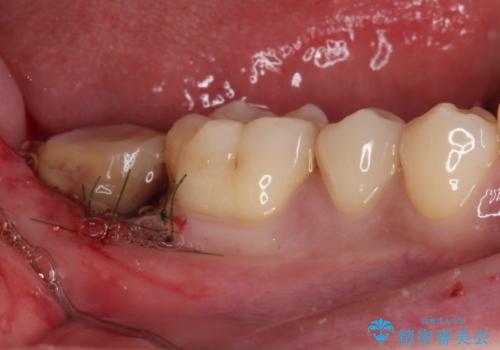 被せものが入れられない 外科処置を行ったセラミック治療の治療中