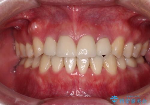 八重歯と開咬を治したい 目立たないハーフリンガル矯正の症例 治療後