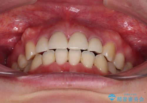八重歯と開咬を治したい　目立たないハーフリンガル矯正の治療後