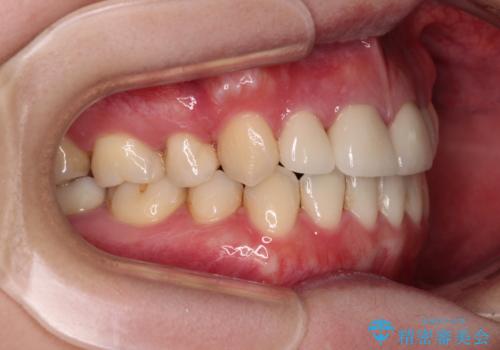 八重歯と開咬を治したい 目立たないハーフリンガル矯正の治療後