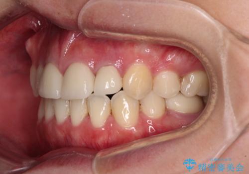 八重歯と開咬を治したい　目立たないハーフリンガル矯正の治療後