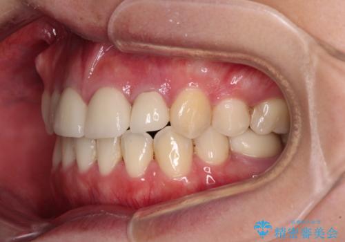 八重歯と開咬を治したい 目立たないハーフリンガル矯正の治療後