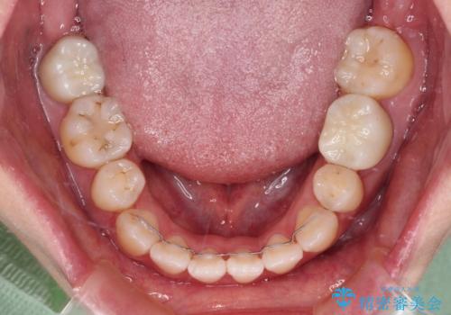 八重歯と開咬を治したい 目立たないハーフリンガル矯正の治療後