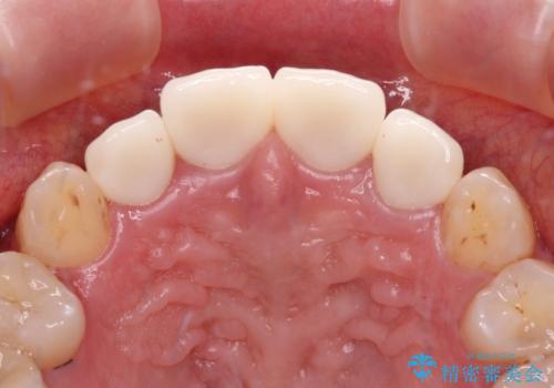 八重歯と開咬を治したい 目立たないハーフリンガル矯正の治療後