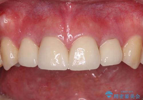 八重歯と開咬を治したい 目立たないハーフリンガル矯正の治療後