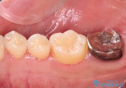 被せものが入れられない 外科処置を行ったセラミック治療の治療前