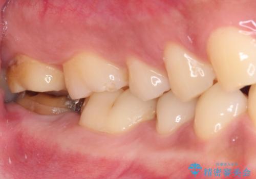 被せものが入れられない 外科処置を行ったセラミック治療の治療前