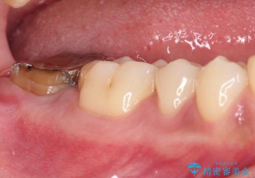 被せものが入れられない 外科処置を行ったセラミック治療の治療前