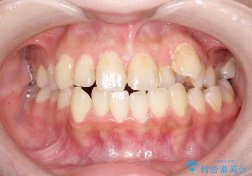 八重歯をインビザラインで非抜歯矯正の治療前