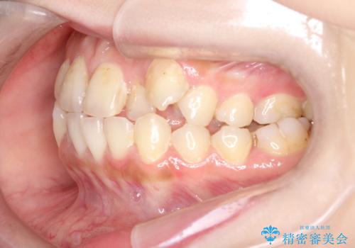 八重歯をインビザラインで非抜歯矯正の治療前