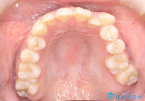 八重歯をインビザラインで非抜歯矯正の治療前