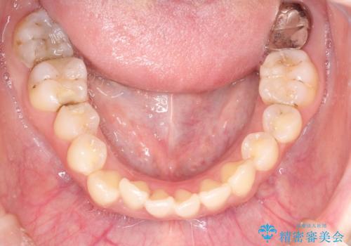 八重歯をインビザラインで非抜歯矯正の治療前