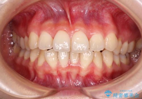 前歯のクロスバイト　ワイヤー装置を併用したインビザライン矯正の治療中