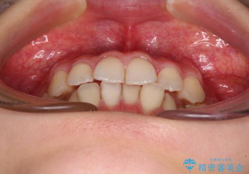 前歯のクロスバイト ワイヤー装置を併用したインビザライン矯正の治療中