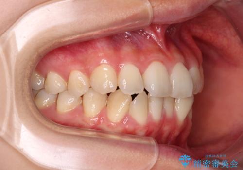 前歯のクロスバイト ワイヤー装置を併用したインビザライン矯正の治療中