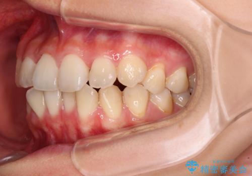 前歯のクロスバイト ワイヤー装置を併用したインビザライン矯正の治療中