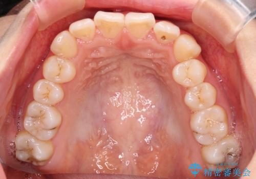 前歯のクロスバイト ワイヤー装置を併用したインビザライン矯正の治療中