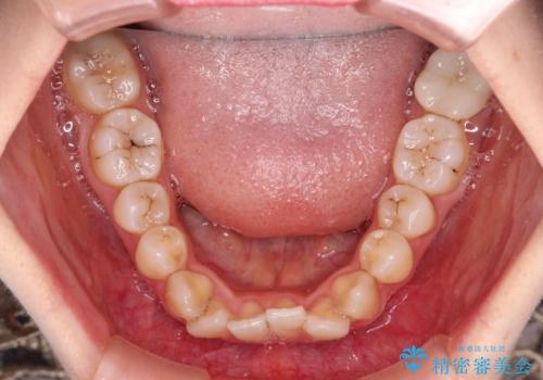 前歯のクロスバイト ワイヤー装置を併用したインビザライン矯正の治療中