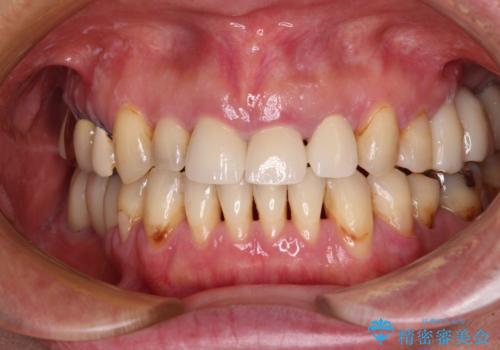 反対咬合や欠損を治療したい インビザライン矯正とオールセラミックブリッジ