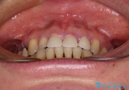 反対咬合や欠損を治療したい インビザライン矯正とオールセラミックブリッジの治療後