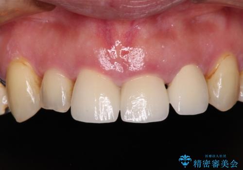 反対咬合や欠損を治療したい インビザライン矯正とオールセラミックブリッジの治療後