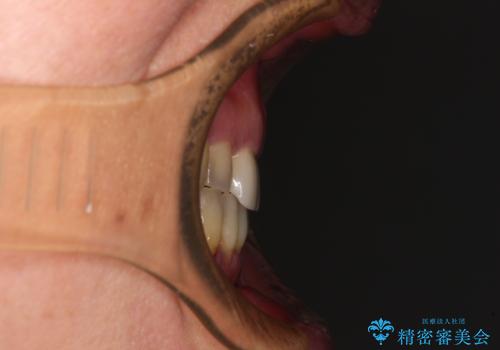 反対咬合や欠損を治療したい インビザライン矯正とオールセラミックブリッジの治療後