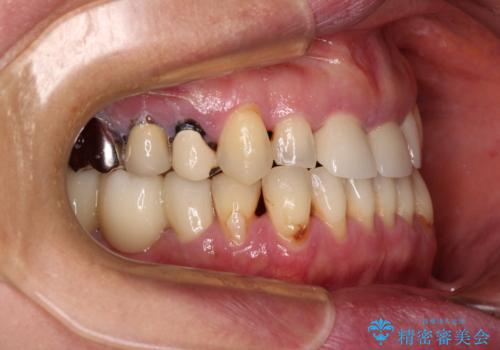 反対咬合や欠損を治療したい インビザライン矯正とオールセラミックブリッジの治療後