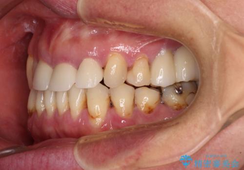 反対咬合や欠損を治療したい インビザライン矯正とオールセラミックブリッジの治療後