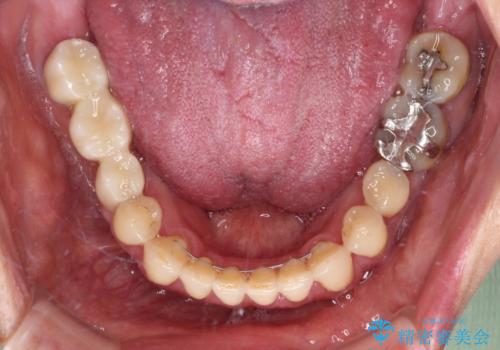 反対咬合や欠損を治療したい インビザライン矯正とオールセラミックブリッジの治療後