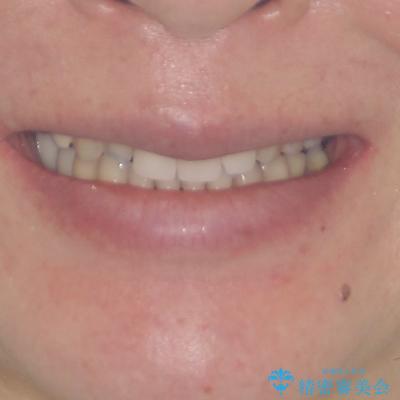 反対咬合や欠損を治療したい インビザライン矯正とオールセラミックブリッジの治療後(顔貌)
