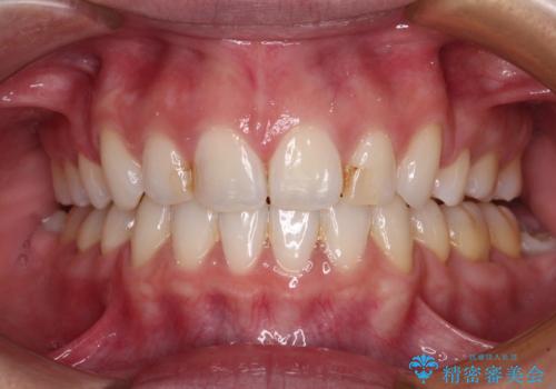 唇を閉じやすく　出っ歯の抜歯矯正の症例 治療後