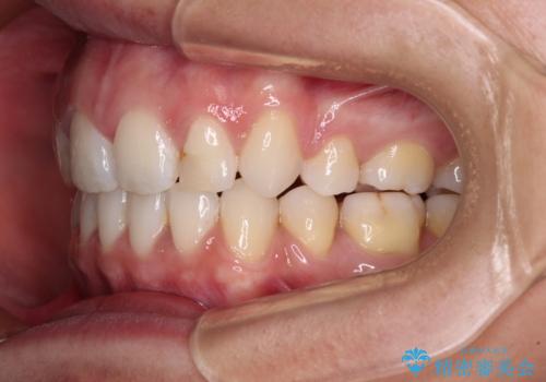 唇を閉じやすく　出っ歯の抜歯矯正の治療後
