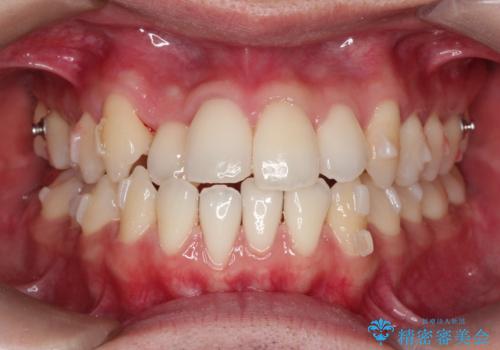 前歯が反対に咬んでいる インビザラインによる矯正治療の治療中