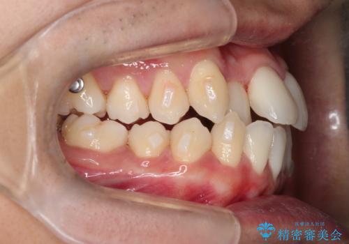 前歯が反対に咬んでいる インビザラインによる矯正治療の治療中