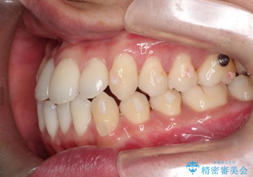 前歯が反対に咬んでいる インビザラインによる矯正治療の治療中