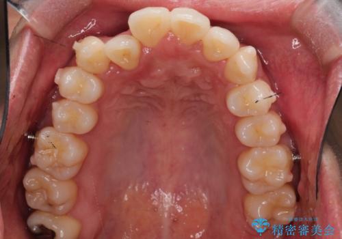 前歯が反対に咬んでいる　インビザラインによる矯正治療の治療中