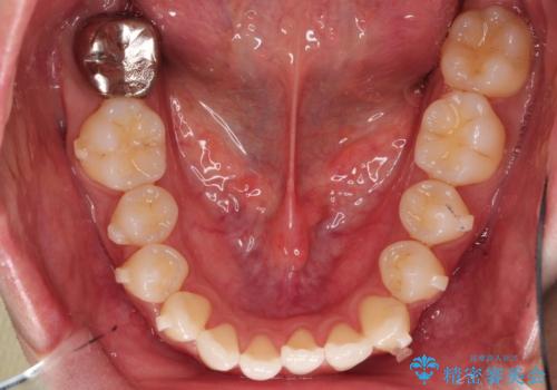 前歯が反対に咬んでいる　インビザラインによる矯正治療の治療中