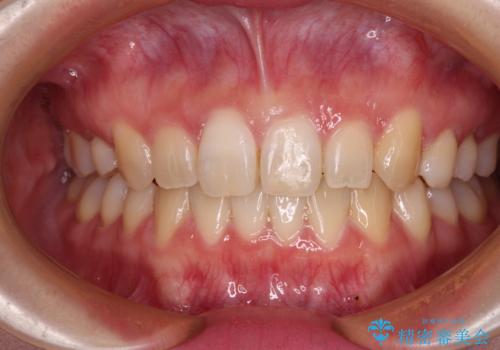 ディープバイトをインビザライン矯正で改善の症例 治療後